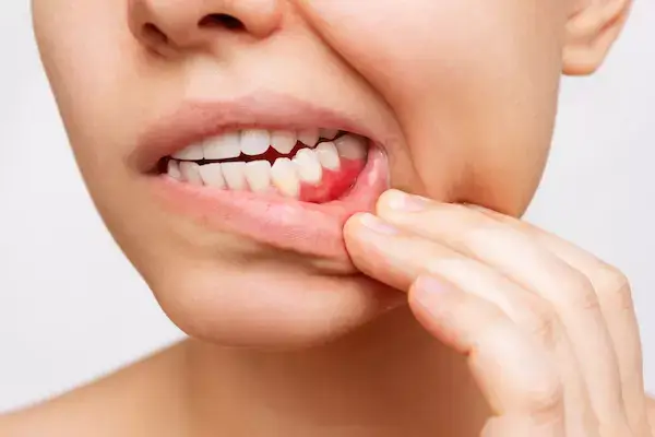 Gum Disease Tteatment Larchmont | Eric Spellman DMD | Dentist Larchmont NY