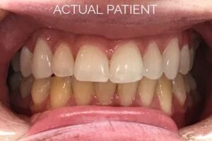 Teeth Whitening Larchmont