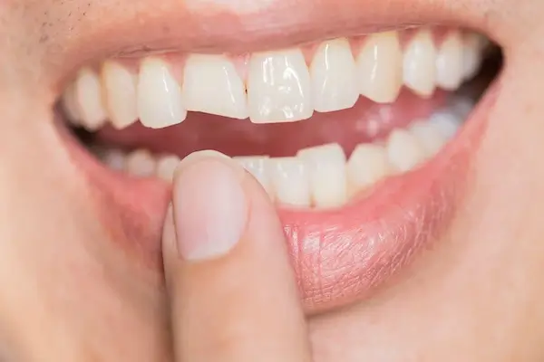 Broken & Chipped Tooth Repair Larchmont